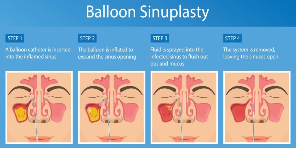 Step-by-Step Balloon Sinusplasty Procedure
