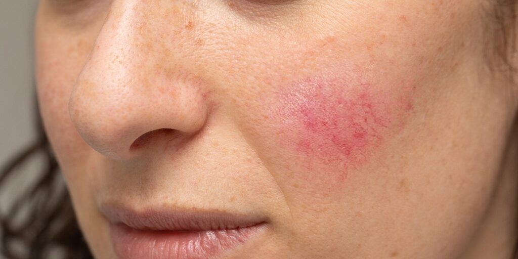 Closeup of spider veins on a woman's face