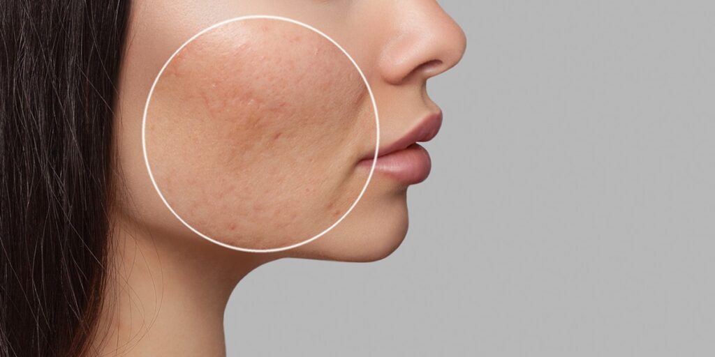 Profile of woman's face focusing on patch on cheek
